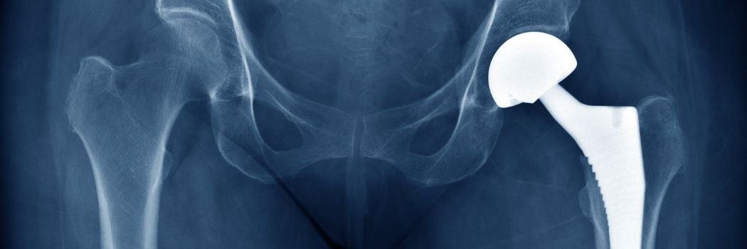 An x-ray of a hip replacement